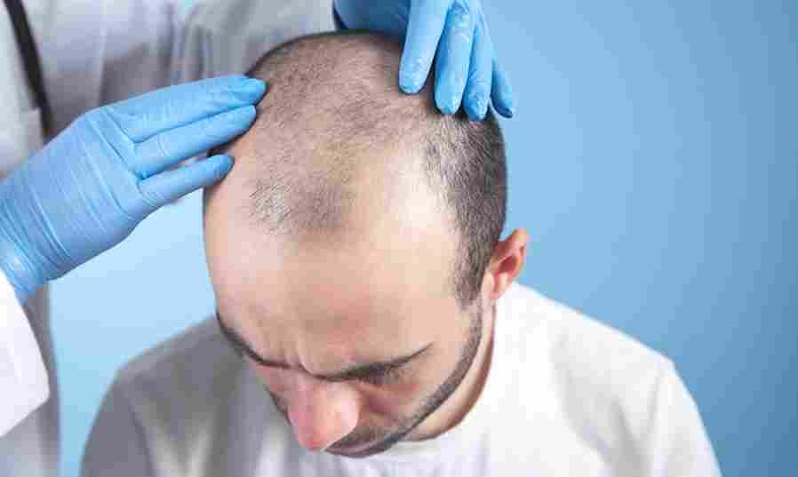 Hair Transplant – Step-by-Step Process Explained