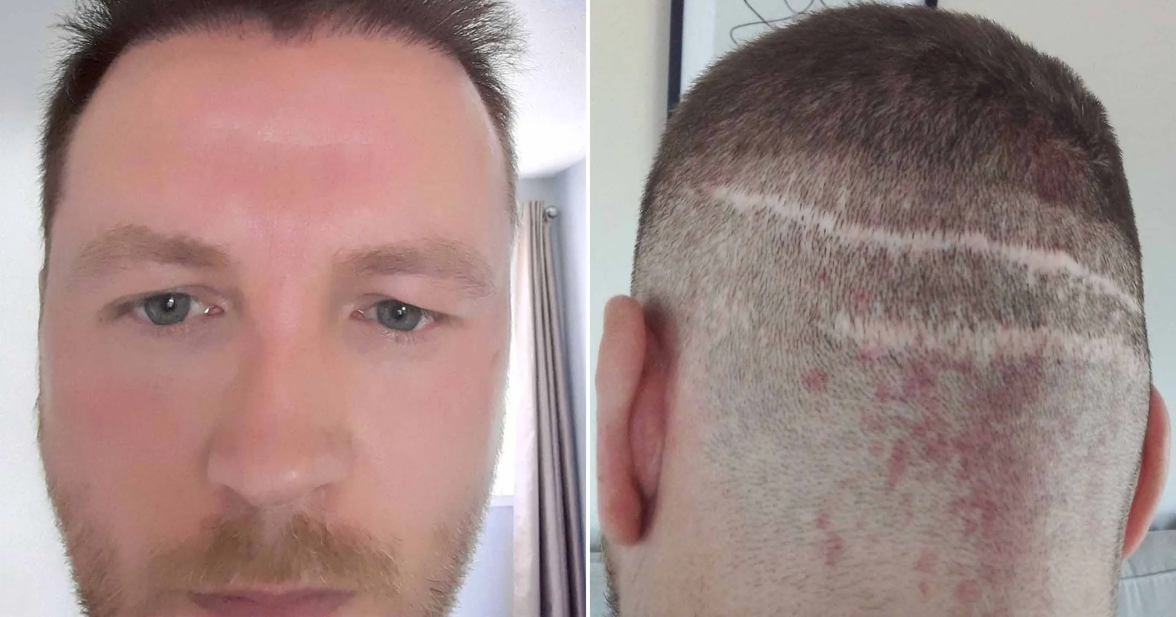 Hair Transplant UK for Men and Women – Safe and Effective