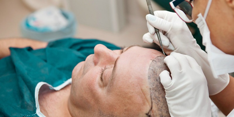 Hair Transplant Istanbul – Your Journey to Natural Hair Starts Here